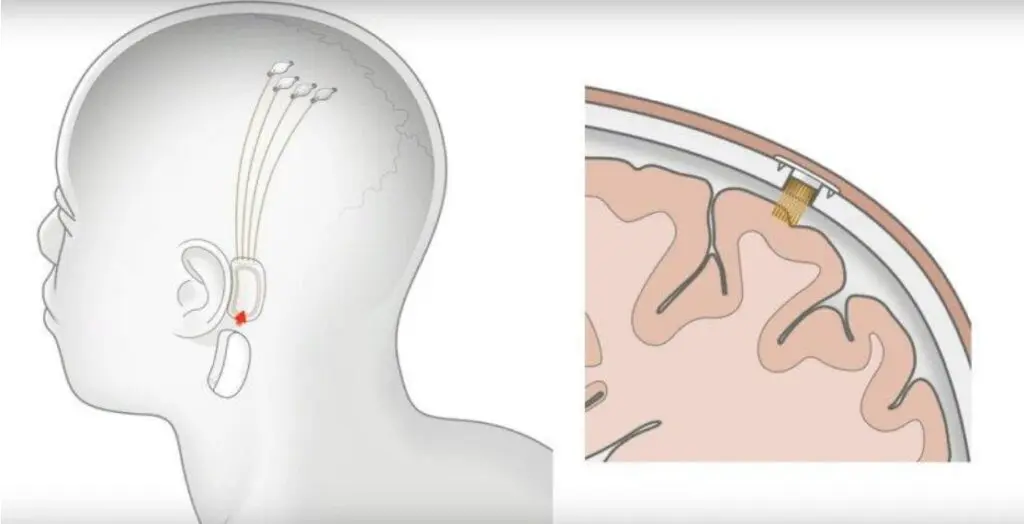 Elon-Musks-Neuralink-Technology-A-Brain-Hacking-Technology-or-a-Neuroscientific-Breakthrough